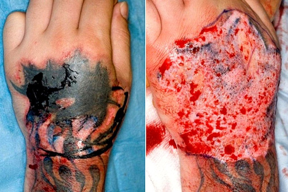 Principais riscos associados a tatuagem antes e depois de